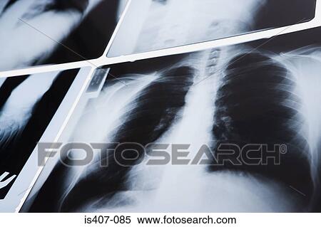 Chest x-ray View Large Photo Image Stock Photography - Chest x-ray. Fotosearch