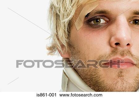 Stock Image - Man with a black eye. Fotosearch