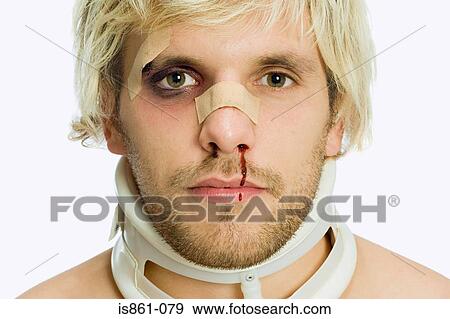Stock Photo - Man with a black eye wearing neck collar. Fotosearch
