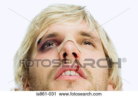 Man with black eye and bleeding nose View Large Photo Image Stock Image - Man with black eye and bleeding nose. Fotosearch