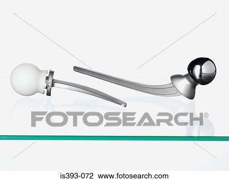 Hip replacement View Large Photo Image Stock Image - Hip replacement. Fotosearch