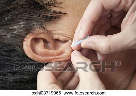 Acupuncture treatment View Large Photo Image Stock Photography - Acupuncture treatment. Fotosearch