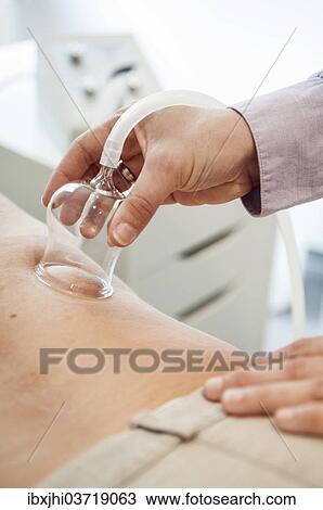 "Cupping therapy, cupping glass on a patient's back" View Large Photo Image Stock Image - "Cupping therapy, cupping glass on a patient's back". Fotosearch