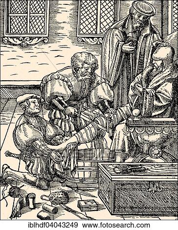 Stock Photo - "Amputation of a leg in the 16th century, historical illustration". Fotosearch