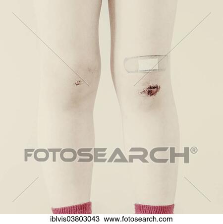 Child's legs with bruises and band-aid View Large Photo Image Stock Image - Child's legs with bruises and band-aid. Fotosearch