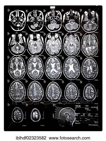 "Computed tomography, CT scan of the head of a young woman who has multiple sclerosis, MS" View Large Photo Image Stock Image - "Computed tomography, CT scan of the head of a young woman who has multiple sclerosis, MS". Fotosearch