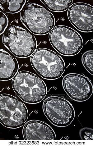 Stock Image - "Computed tomography, CT scan of the head of a young woman who has multiple sclerosis, MS". Fotosearch