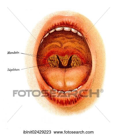 "Diphtheria of the tonsils and uvula, illustration from Meyers Konversationslexikon, a German encyclopedia, 1897" View Large Photo Image Stock Image - "Diphtheria of the tonsils and uvula, illustration from Meyers Konversationslexikon, a German encyclopedia, 1897". Fotosearch