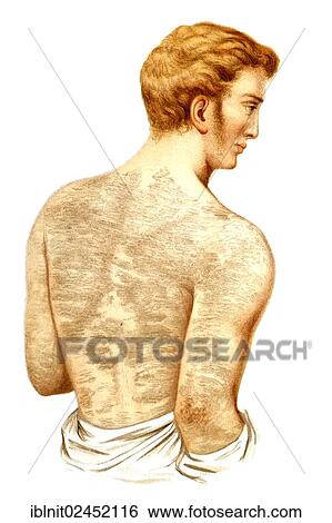 "Fish scale disease, illustration, Meyers Konversations-Lexikon encyclopedia, 1897" View Large Photo Image Stock Photograph - "Fish scale disease, illustration, Meyers Konversations-Lexikon encyclopedia, 1897". Fotosearch