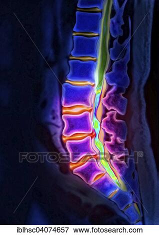 "Herniated disk, lumbar vertebra, computed tomography" View Large Photo Image Stock Photo - "Herniated disk, lumbar vertebra, computed tomography". Fotosearch