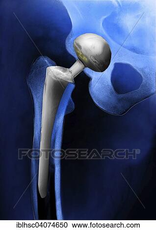 "Hip prosthesis, endoprosthesis of the hip joint, hip replacement, X-ray" View Large Photo Image Stock Image - "Hip prosthesis, endoprosthesis of the hip joint, hip replacement, X-ray". Fotosearch
