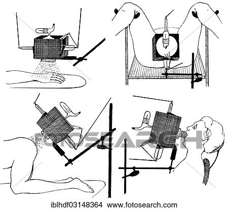 "Irradiation of the hand, mouth, genital and anal regions, state of the art of therapeutic techniques, early 20th Century, illustration" View Large Photo Image Picture - "Irradiation of the hand, mouth, genital and anal regions, state of the art of therapeutic techniques, early 20th Century, illustration". Fotosearch