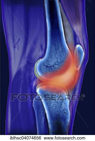 "Knee joint, Articulatio genus, area of pain, computed tomography" View Large Photo Image Stock Photograph - "Knee joint, Articulatio genus, area of pain, computed tomography". Fotosearch