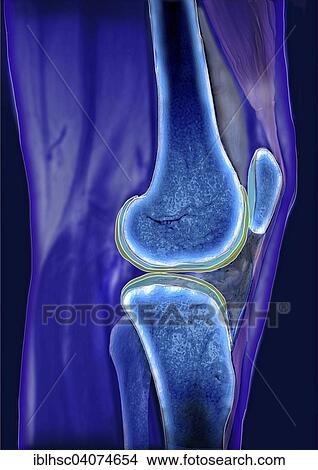 "Knee joint, Articulatio genus, computed tomography" View Large Photo Image Picture - "Knee joint, Articulatio genus, computed tomography". Fotosearch