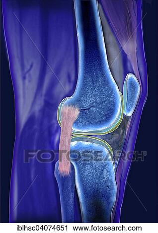 "Knee joint, Articulatio genus, collateral ligament, computed tomography" View Large Photo Image Stock Image - "Knee joint, Articulatio genus, collateral ligament, computed tomography". Fotosearch