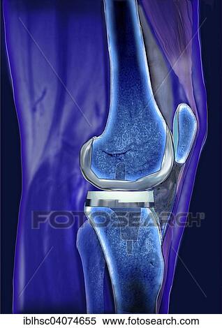 "Knee joint, Articulatio genus, prosthesis, computed tomography" View Large Photo Image Stock Photography - "Knee joint, Articulatio genus, prosthesis, computed tomography". Fotosearch