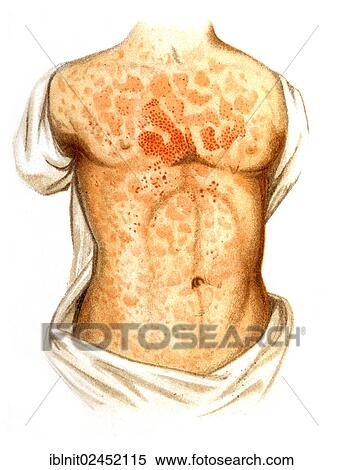 "Measles, illustration, Meyers Konversations-Lexikon encyclopedia, 1897" View Large Photo Image Stock Photography - "Measles, illustration, Meyers Konversations-Lexikon encyclopedia, 1897". Fotosearch