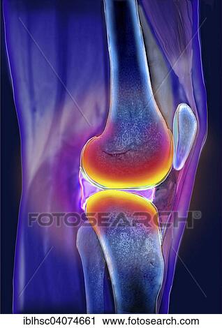 "Meniscus, area of pain, computed tomography" View Large Photo Image Stock Image - "Meniscus, area of pain, computed tomography". Fotosearch