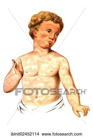 "Scarlet fever, illustration, Meyers Konversations-Lexikon encyclopedia, 1897" View Large Photo Image Picture - "Scarlet fever, illustration, Meyers Konversations-Lexikon encyclopedia, 1897". Fotosearch