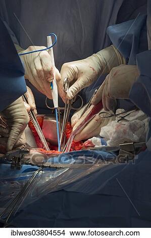 "Surgeons perform a hysterectomy on a woman with endometrial cancer at Karmanos Cancer Institute, Detroit, Michigan, United States, North America" View Large Photo Image Picture - "Surgeons perform a hysterectomy on a woman with endometrial cancer at Karmanos Cancer Institute, Detroit, Michigan, United States, North America". Fotosearch