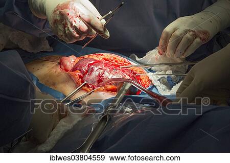 "Surgeons perform a hysterectomy on a woman with endometrial cancer at Karmanos Cancer Institute, Detroit, Michigan, United States, North America" View Large Photo Image Stock Photo - "Surgeons perform a hysterectomy on a woman with endometrial cancer at Karmanos Cancer Institute, Detroit, Michigan, United States, North America". Fotosearch