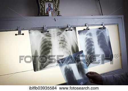 Picture - "Tuberculosis and HIV in Moldova, x-rays, Moldova, Europe". Fotosearch