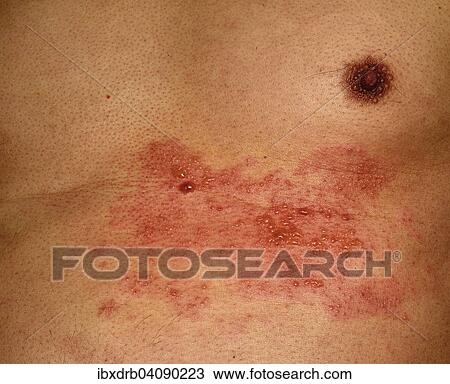 Stock Photo Of Shingles Or Herpes Zoster In The Chest Area Of A Man