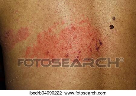 Shingles or herpes zoster, with secondary finding of dysplastic nevi, atypical moles, man, 56 years View Large Photo Image Stock Image - Shingles or herpes zoster, with secondary finding of dysplastic nevi, atypical moles, man, 56 years. Fotosearch