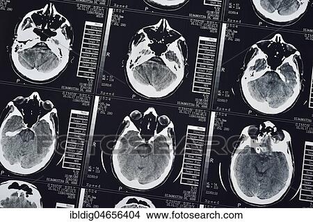 Picture - CT Scan of a human male brain, close up. Fotosearch
