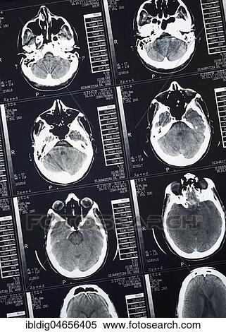 CT Scan of a human male brain, close up View Large Photo Image Stock Photography - CT Scan of a human male brain, close up. Fotosearch