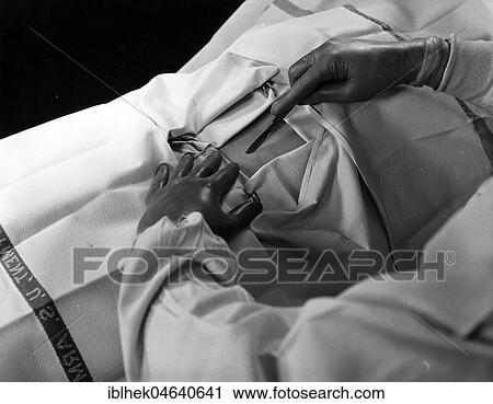 Stock Image - Medicine, health, doctor uses scalpel for cut, operation on the stomach, ca. 1940s, exact location unknown, Germany, Europe. Fotosearch
