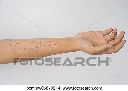 Picture - Allergy test, prick test, skin test, different ingredients are tested for allergic reactions, arm with markings, Germany, Europe. Fotosearch