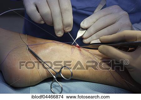 Operation, pulling varicose veins, vascular surgery, Düsseldorf, North Rhine-Westphalia, Germany, Europe View Large Photo Image Picture - Operation, pulling varicose veins, vascular surgery, Düsseldorf, North Rhine-Westphalia, Germany, Europe. Fotosearch