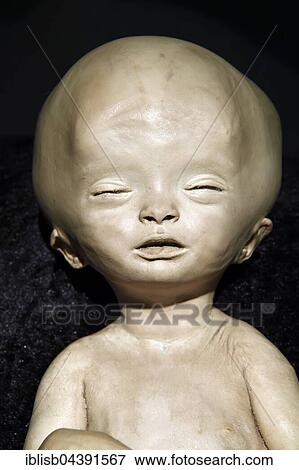 Stock Photo - Plastinate, child with hydrocephalus, Body Worlds, Menschen Museum, Berlin, Germany, Europe. Fotosearch