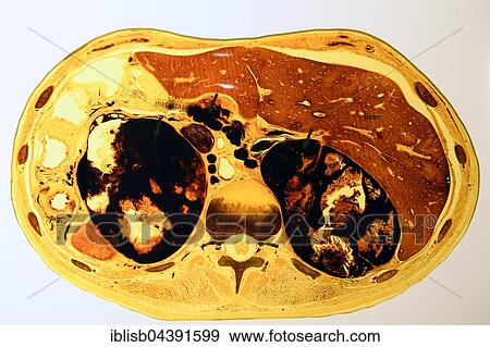 Plastinate, cross section of human abdomen with skin cancer metastases, Body Worlds, Menschen Museum, Berlin, Germany, Europe View Large Photo Image Stock Photo - Plastinate, cross section of human abdomen with skin cancer metastases, Body Worlds, Menschen Museum, Berlin, Germany, Europe. Fotosearch