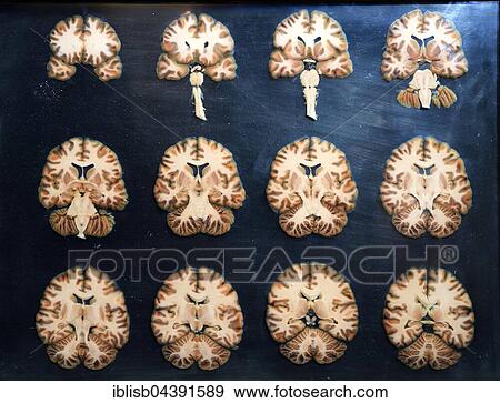 Stock Photo - Plastinate, cross sections through human brain, Body Worlds, Menschen Museum, Berlin, Germany, Europe. Fotosearch