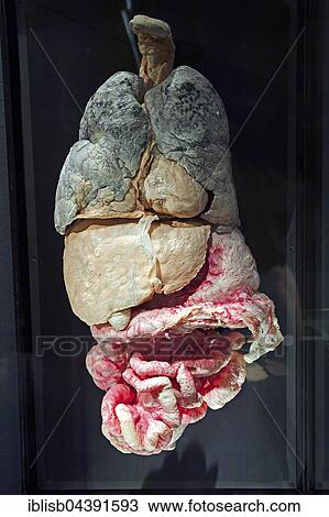 Plastinate, human abdomen, internal organs with metastases, Body Worlds, Menschen Museum, Berlin, Germany, Europe View Large Photo Image Stock Image - Plastinate, human abdomen, internal organs with metastases, Body Worlds, Menschen Museum, Berlin, Germany, Europe. Fotosearch