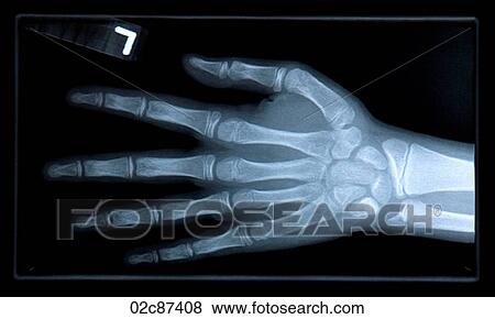 Close-up of xray of hand. View Large Photo Image Stock Photo - Close-up of xray of hand.. Fotosearch