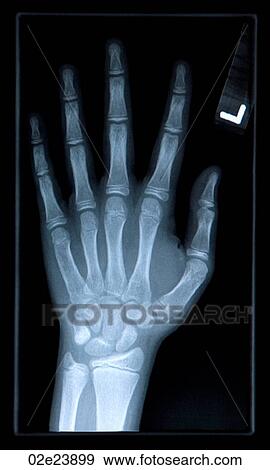 Close-up of xray of hand. View Large Photo Image Stock Photo - Close-up of xray of hand.. Fotosearch