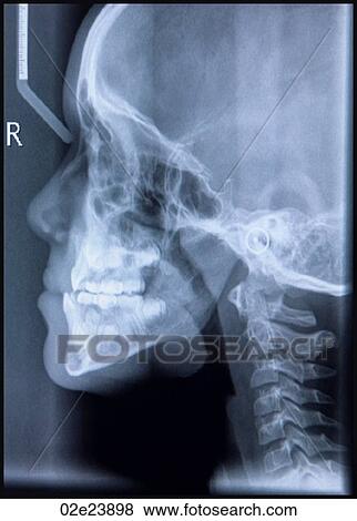 Profile xray of a skull. View Large Photo Image Stock Photo - Profile xray of a skull.. Fotosearch