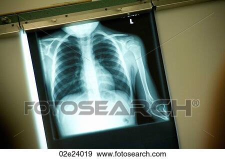 X-ray of torso. View Large Photo Image Stock Photo - X-ray of torso.. Fotosearch