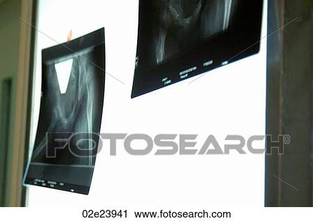 Stock Image - X-Rays on light board.. Fotosearch