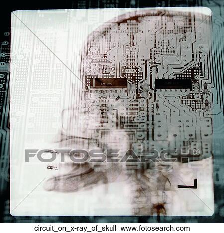 Circuit on x-ray of skull View Large Photo Image Stock Image - Circuit on x-ray of skull. Fotosearch