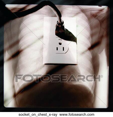 Stock Photo - Socket on chest x-ray. Fotosearch