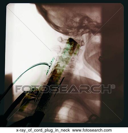 Stock Image - X-ray of cord plug in neck. Fotosearch
