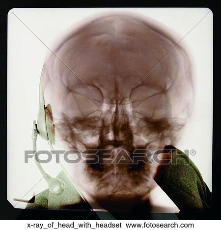 X-ray of head with headset View Large Photo Image Stock Photograph - X-ray of head with headset. Fotosearch