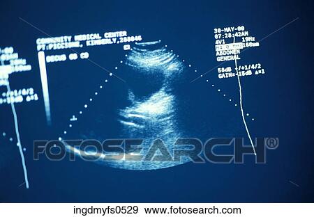 Ultrasound Image View Large Photo Image Stock Photo - Ultrasound Image. Fotosearch