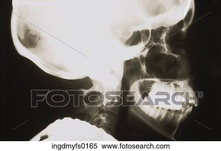 Stock Photography - Xray of Skull. Fotosearch