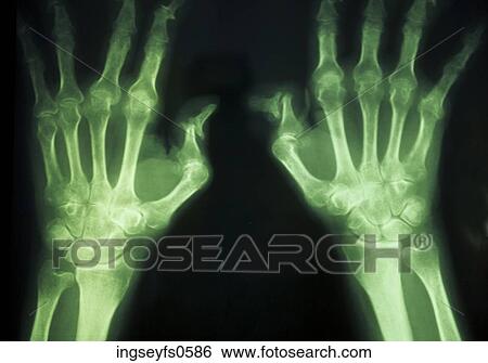 Stock Photograph - X-Ray Hands. Fotosearch
