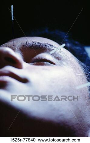 Stock Image - face, acupuncture, health, alternative, treatment. Fotosearch